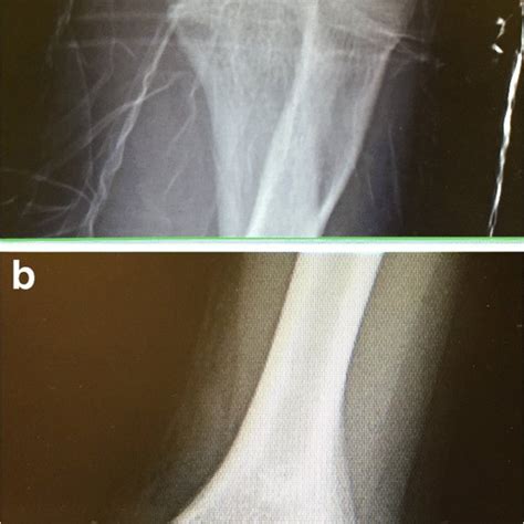 a, b Evaluation of valgus stability of the elbow via the moving valgus ...