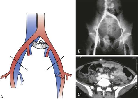 Iliocaval Venous Obstruction Thoracic Key