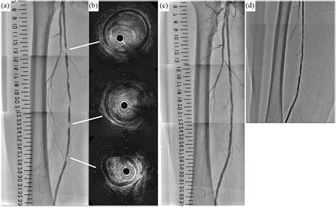 (a) Preoperative angiography of the right SFA, (b) preoperative ...