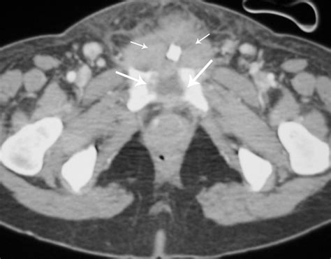 A Computed Tomographic Scan Of The Pelvis Showing Pubic Symphysis