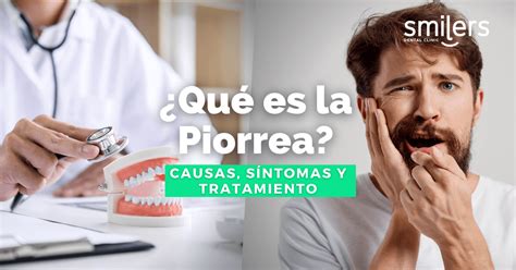 ¿qué Es La Piorrea O Periodontitis Aguda Causas Síntomas Y Tratamiento