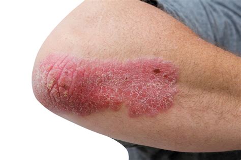 A Look At Psoriasis Harvard Health