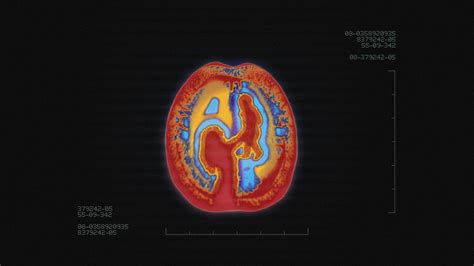 Alzheimer's "Brain Scan" :: Behance