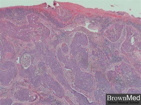 Carcinoma Squamous Cell Carcinoma Of Cervix