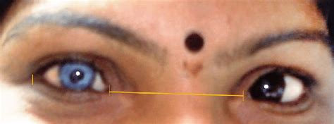 Waardenburg Syndrome Type I Due To Pax3 Mutation With Heterochromia Download Scientific Diagram