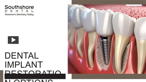 Ppt Dental Implant Restoration Options Powerpoint Presentation Free