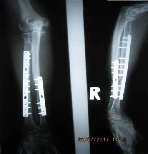 Trauma: Chronic Volkmann’s Contracture (48232) – CSC Staff Teaching and Training