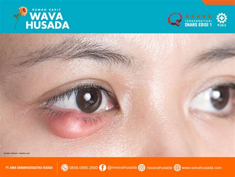 cara cepat menyembuhkan mata bintitan 5