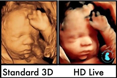 Whats The Difference Between A 3d And 4d Ultrasound 46 Off