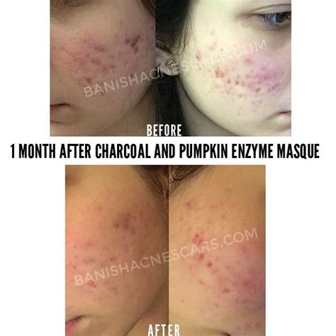 Pin On Getting Rid Of Acne And Scars