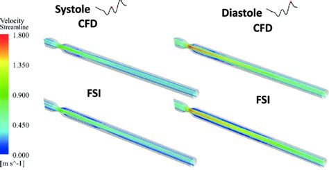 Velocity Streamlines Obtained During Systole And Diastole For Both CFD