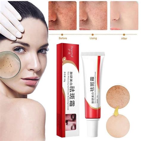 Original Whitening And Freckle Removing Cream Remover Melasma Acne Dark Spot Melanin