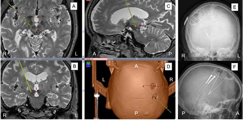 A Case Report Dual Lead Deep Brain Stimulation Of The Posterior