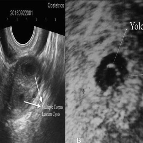 Intrauterine pregnancy with embryo. | Download Scientific Diagram