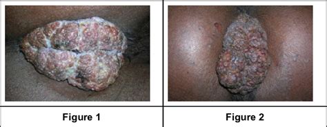 A Neglected Case Of Huge Perianal Wart In An Msm Figure 2 A Large Download Scientific Diagram