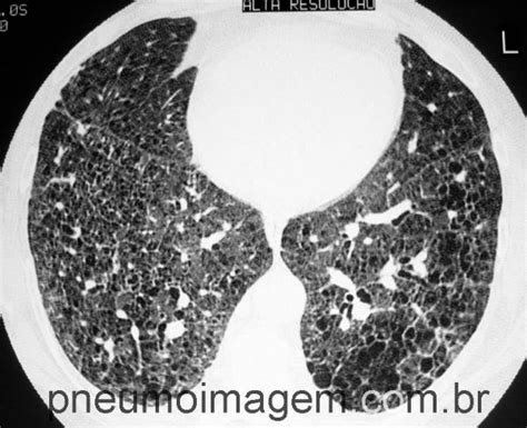 Fibrose Pulmonar IdiopÁtica Uip Pneumoimagem