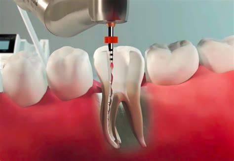 Endodoncja Leczenie Kana Owe K Dental Stomatolog Gda Sk