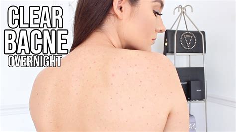 How To Get Rid Of Back Acne Overnight Youtube