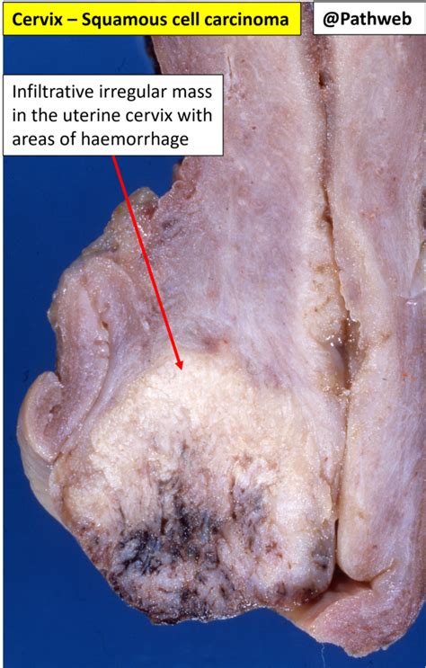 Uterus Cervical Carcinoma Nus Pathweb Nus Pathweb