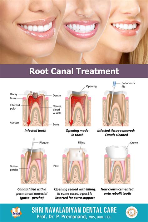 Root Canal Treatment Shri Navaladiyan Dental Care The Multispeciality Hospital