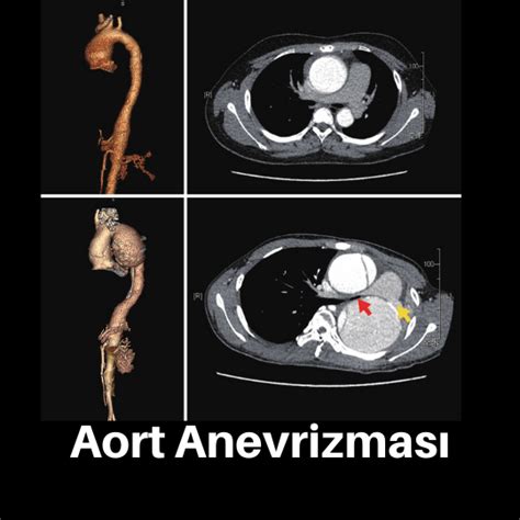 Aort Anevrizmas Nedir Prof Dr Nevrez Koylan