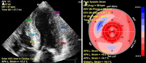 Diagnostic And Prognostic Value Of Cardiac Imaging In Amyloidosis