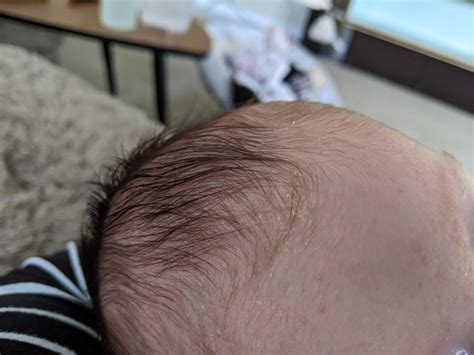 Cradle Cap