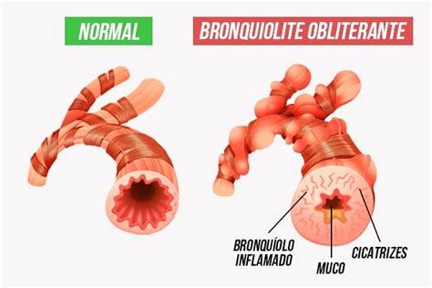 Bronquiolite Obliterante O Que Sintomas Causas E Tratamento Tua