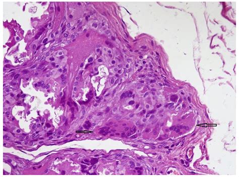 Foreign Body Giant Cells Hematoxylin Eosin ×100 Download