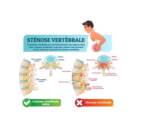 St Nose Spinale Causes Sympt Mes Et Traitements Information