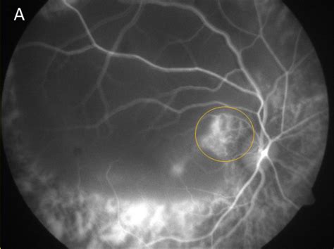 Postvitrectomy Full Thickness Macular Hole And Retinal Detachment In A