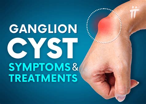 Ganglion Cyst: Symptoms and Treatment Methods - Turan&Turan