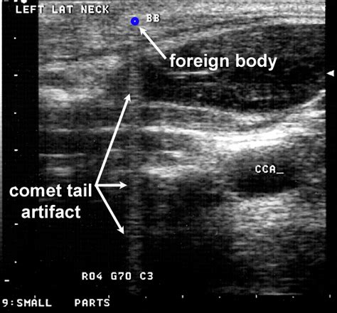 emDOCs.net – Emergency Medicine EducationUltrasound for Retained ...