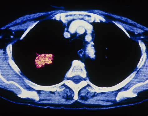 Coloured Ct Scan Showing Cancer Of A Lung Photograph by Pasieka - Pixels