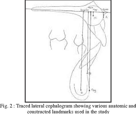 Pdf Palatal Plane And Their Comparision With Angle Anb And Wits Appraisal A Cephalometric