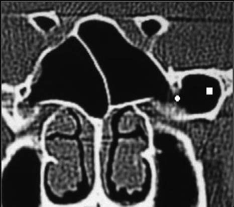 Greater And Lesser Wing Of Sphenoid Ct - slidesharetrick