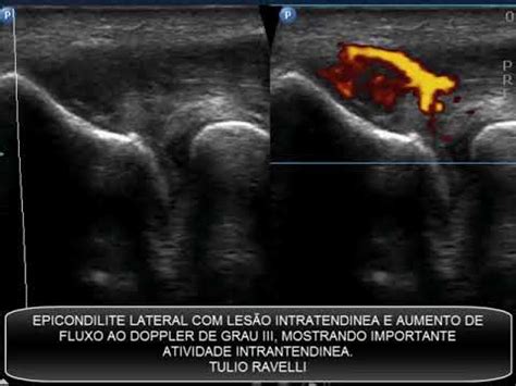 Ultrassom Do Cotovelo Epicondilite Lateral Doppler Youtube