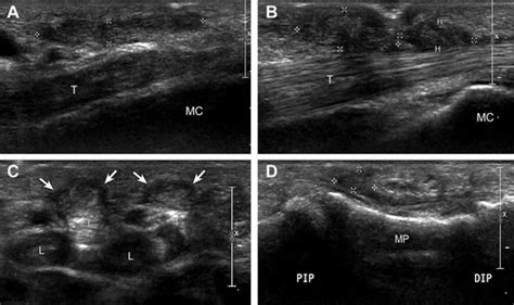 Ultrasound Features Of Palmar Fibromatosis Or Dupuytren Contracture