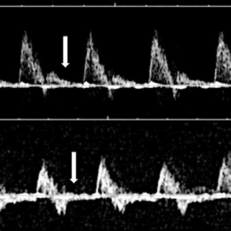 Aortic Isthmus Blood Flow Velocity Waveforms Upper Panel A Waveform