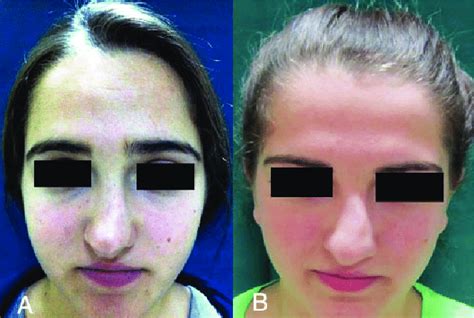 A And B Preoperative Frontal Views Download Scientific Diagram