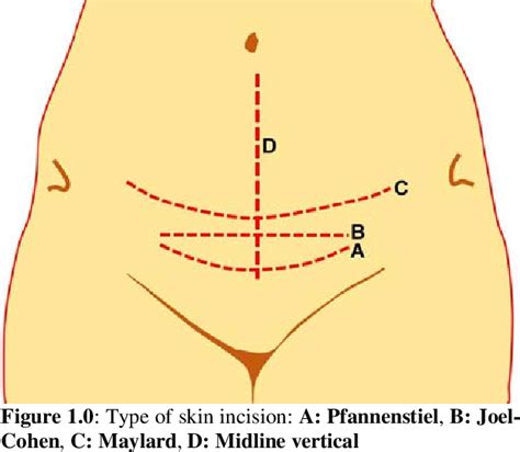 Figure 1 1 From Lower Segment Caesarean Section Evidence Based