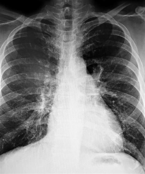 Premium Photo A Chest Xray Shows A Chest Xray