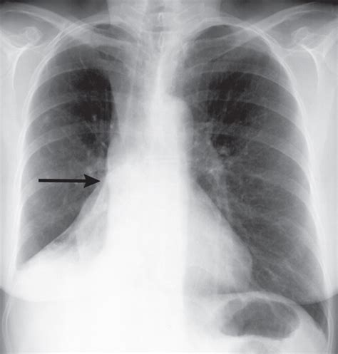 39 Right Lower Lobe Atelectasis Radiology Key