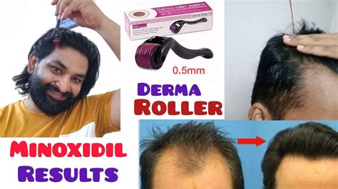 Derma Roller For Hair Growth How To Use Derma Roller On Hairline Minoxidil Hair Regrowth