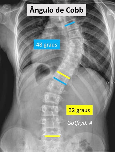 Escoliose Causas Sintomas E Tratamento