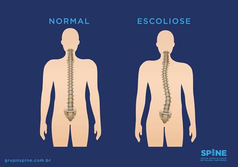 Grupo Spine Conhe A A Escoliose Idiop Tica E Como Ela Afeta Sua Vida