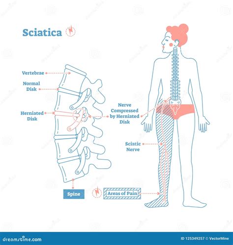 Sciatica Medical Health Care Vector Illustration Diagram Scheme With