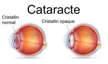 La cataracte symptômes diagnostic et traitement VISIOLE