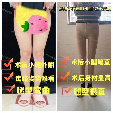 上海丽质卢九宁讲腿型干货：小腿外翻如何改善？ 知乎