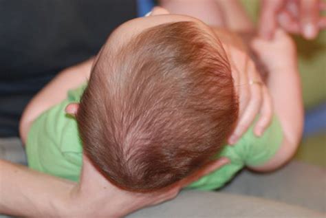 Prevalence Of Positional Plagiocephaly In Teens Born After The Back To